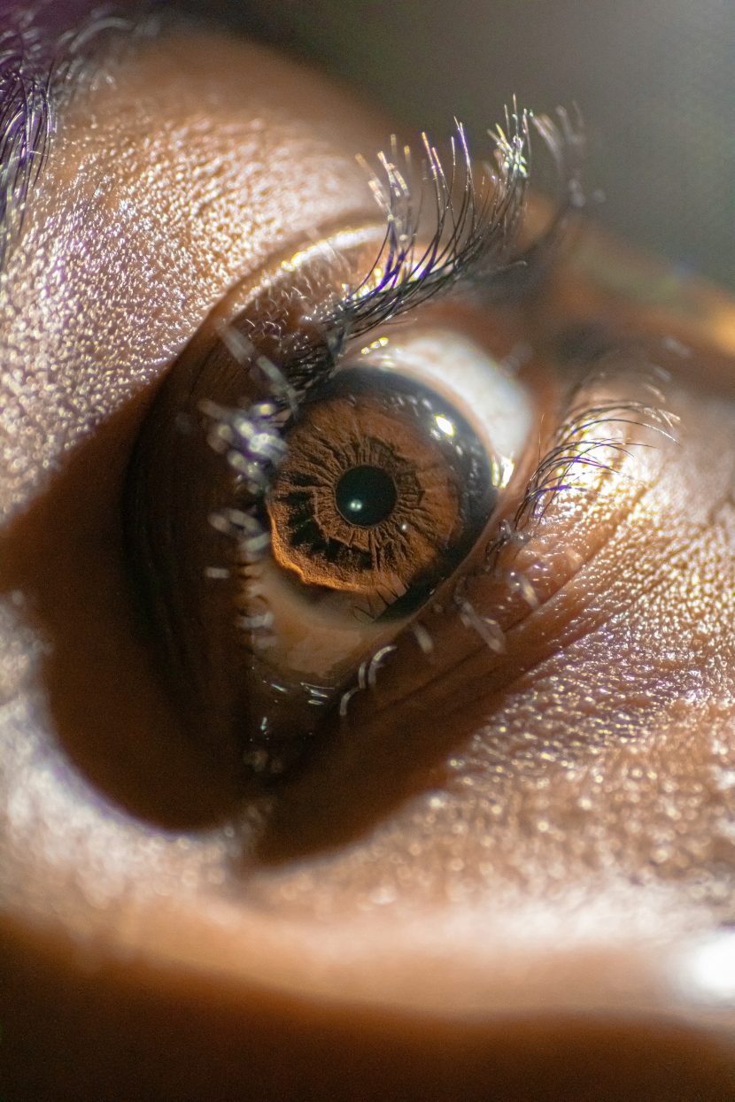 retinal detachment