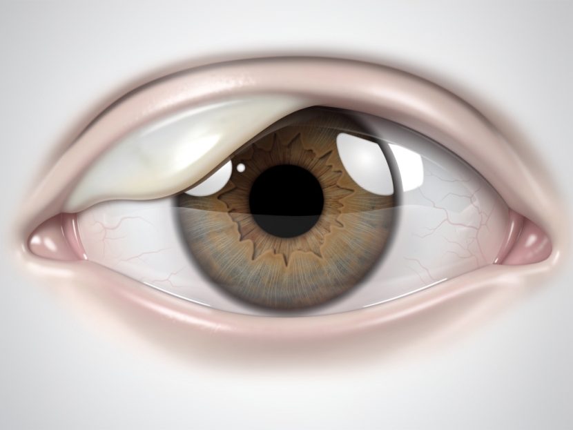Pterygium, often called "surfer’s eye"